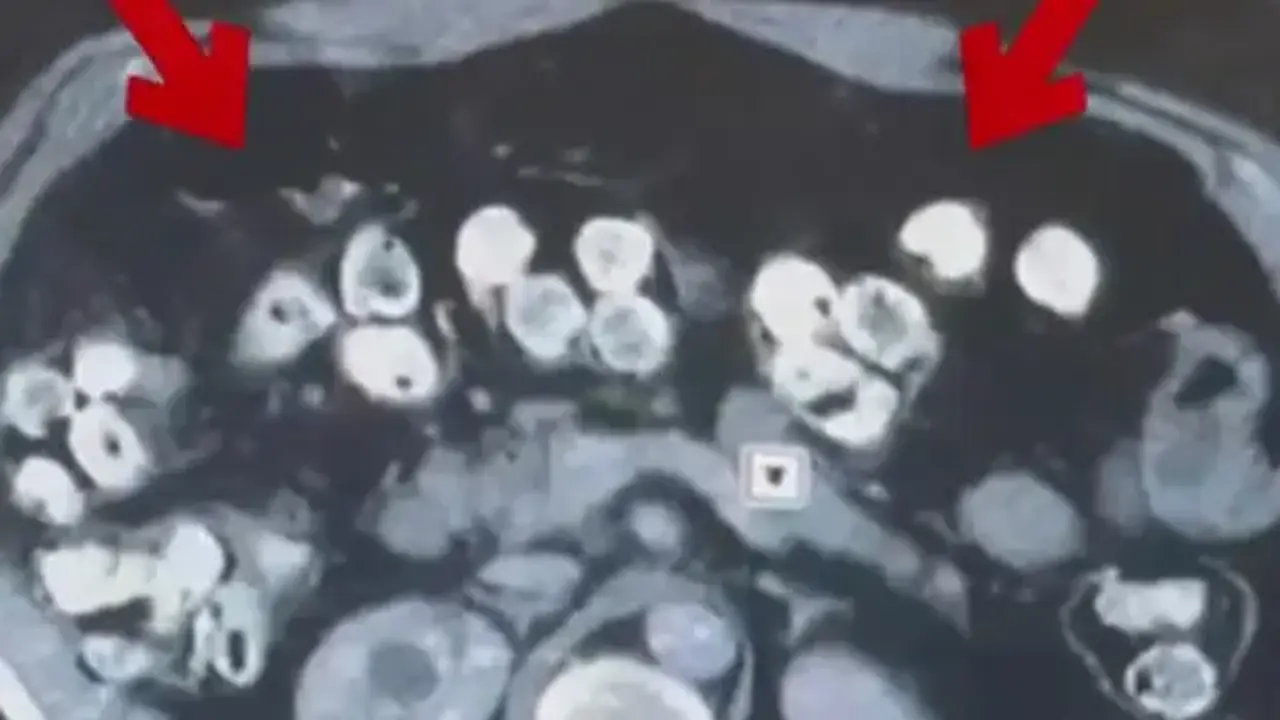2 kilo 675 gram Afyon sakızı yuttuğu tespit edilen 3 şüpheli tutuklandı