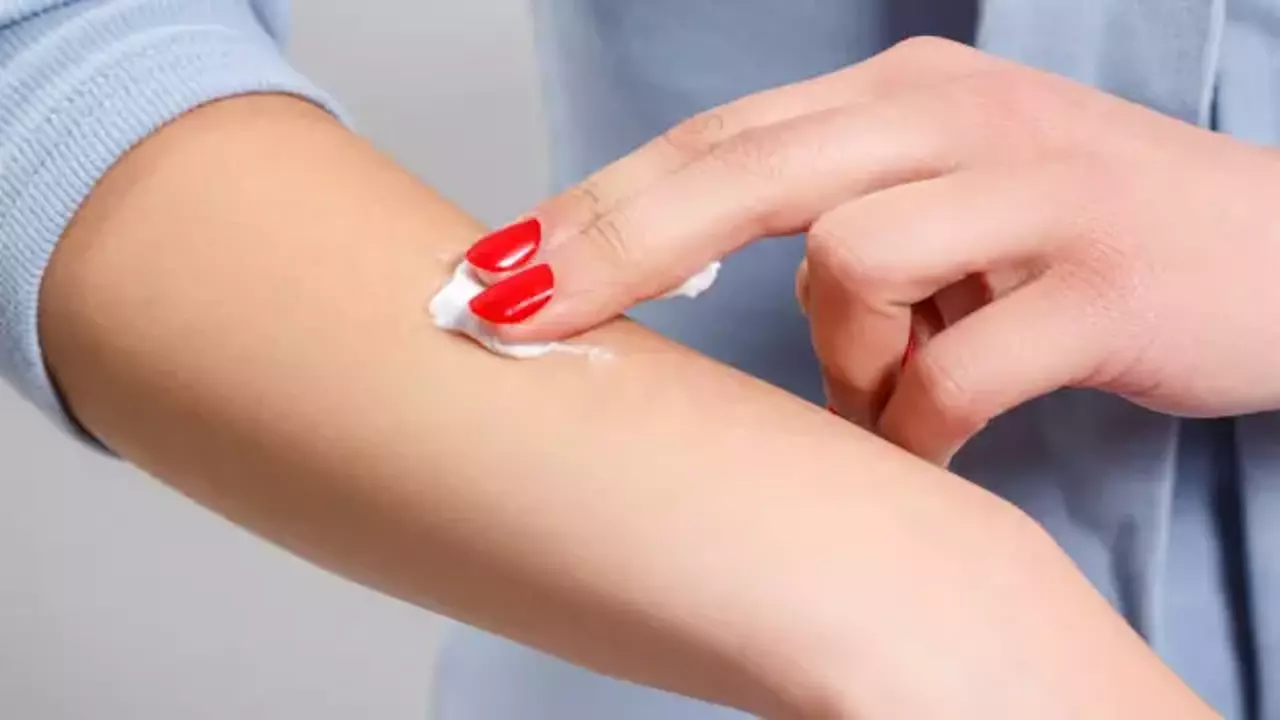 Böcek ısırığı kremi: Bu yaz kaşıntıya son