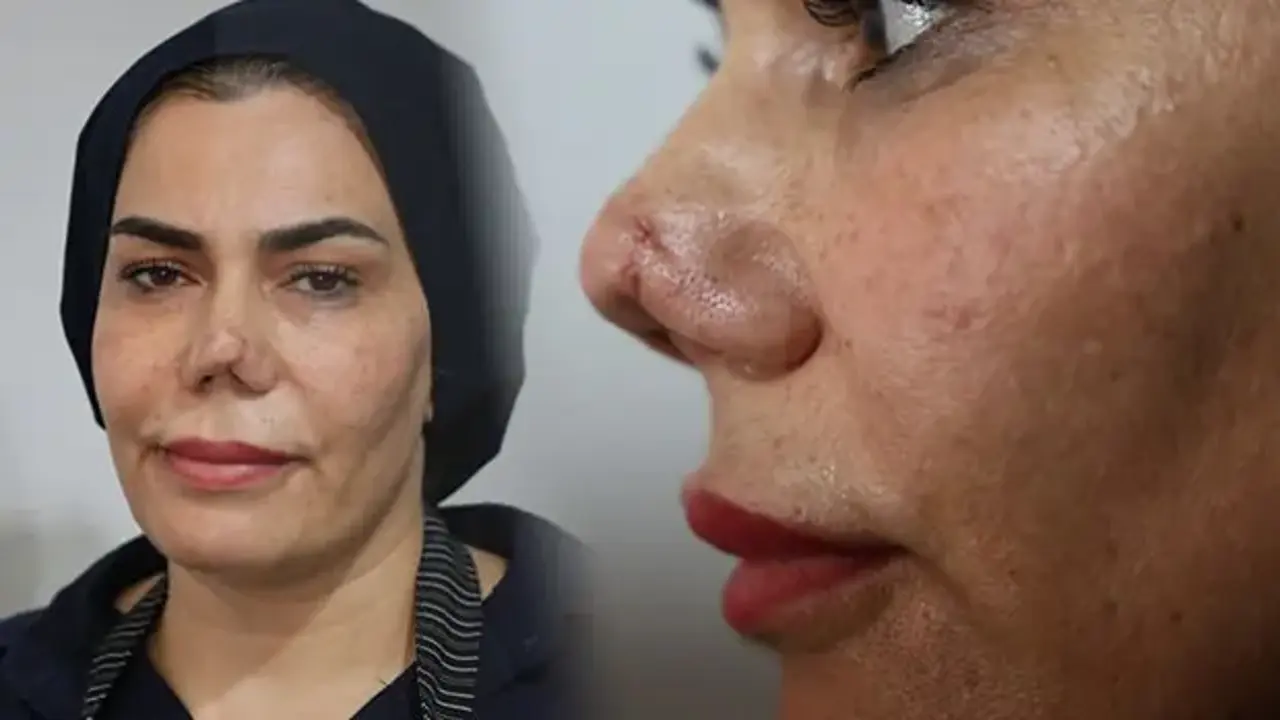 Elazığ'da kaza ile başlayan kabus! Kırılan burnu, 4 operasyonun ardından yırtıldı